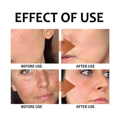 before and after skin improvement using lemon turmeric kojic acid soap showing reduced blemishes and clearer complexion