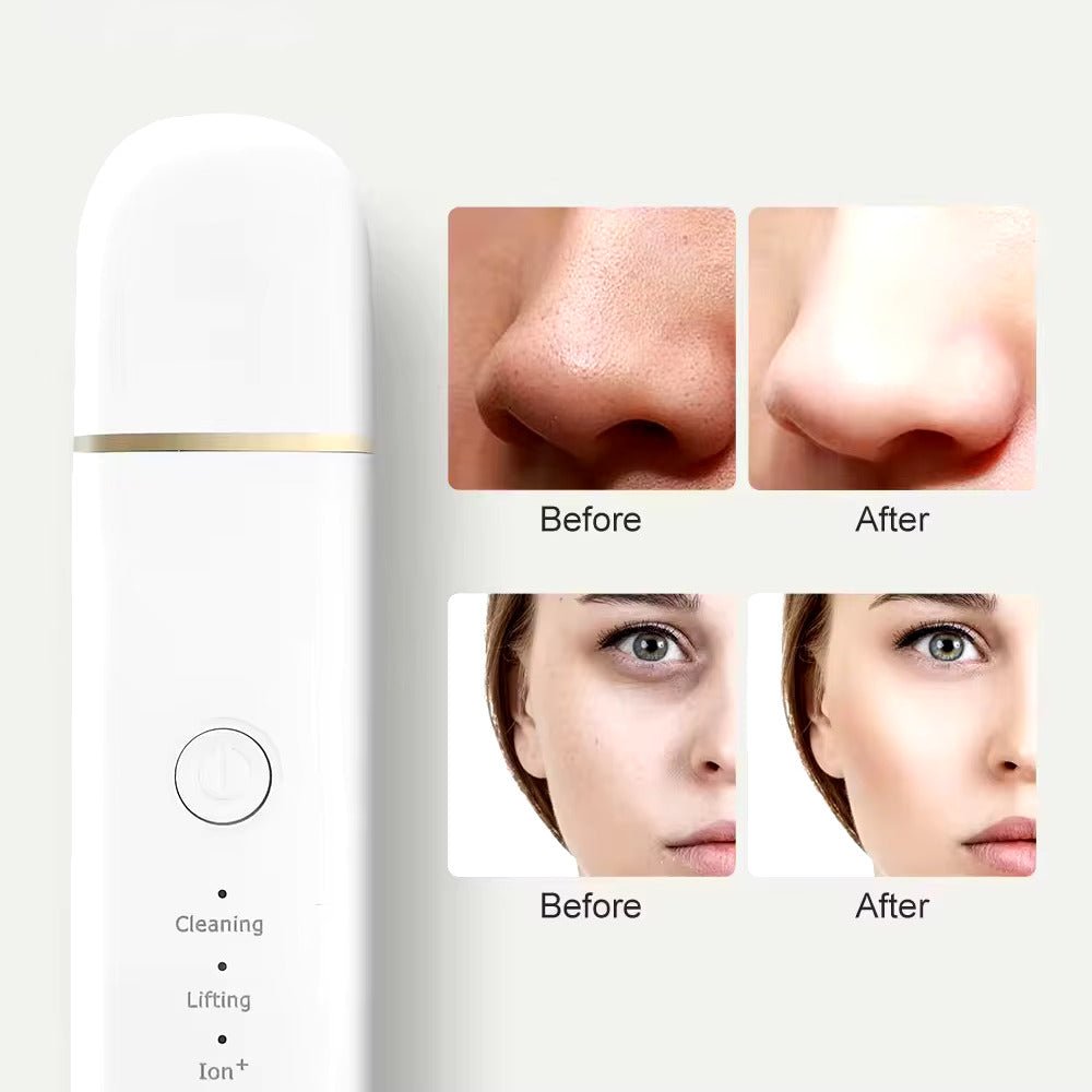 Ultrasonic blackhead remover device with before and after images showing clear skin and reduced blackheads.